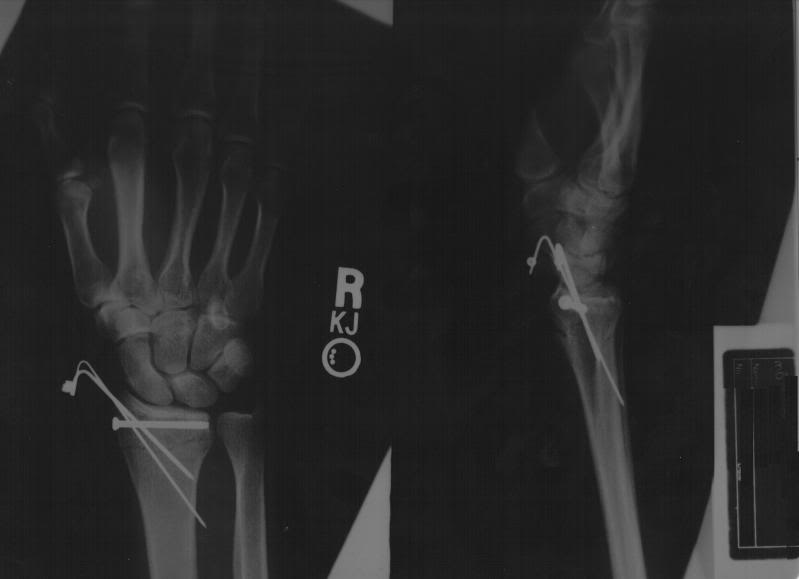 Name:  wrist.jpg
Views: 25
Size:  18.3 KB